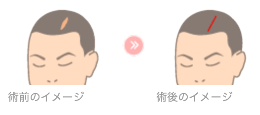 頭部の傷跡 脱毛症 修正術 堺市の美容外科といえば吉田美容形成クリニック