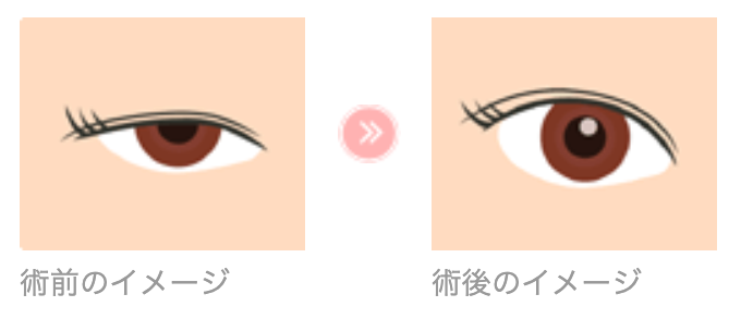 眼瞼下垂 拳筋短縮術 堺市の美容外科といえば吉田美容形成クリニック